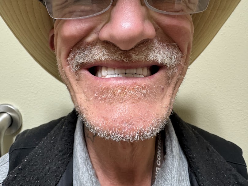 Lonnie smiling with new dentures